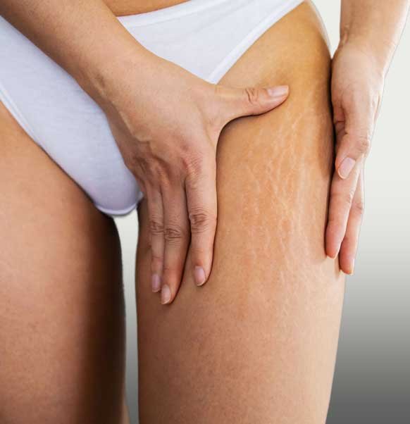 Traitement des vergetures à Paris au Centre KEA