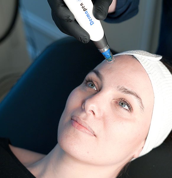 Le microneedling Dermapen 4® au centre KEA à Paris